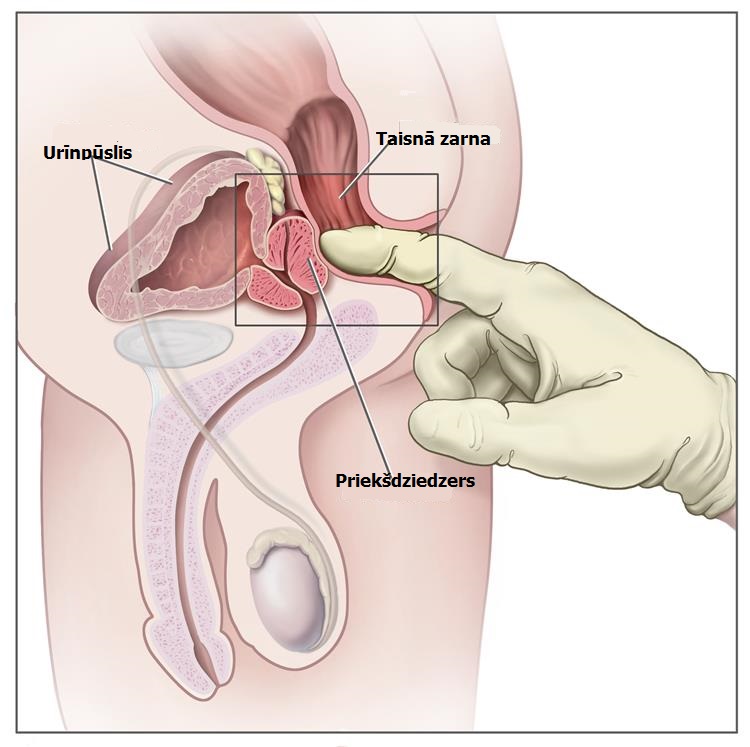 prostatas apskate