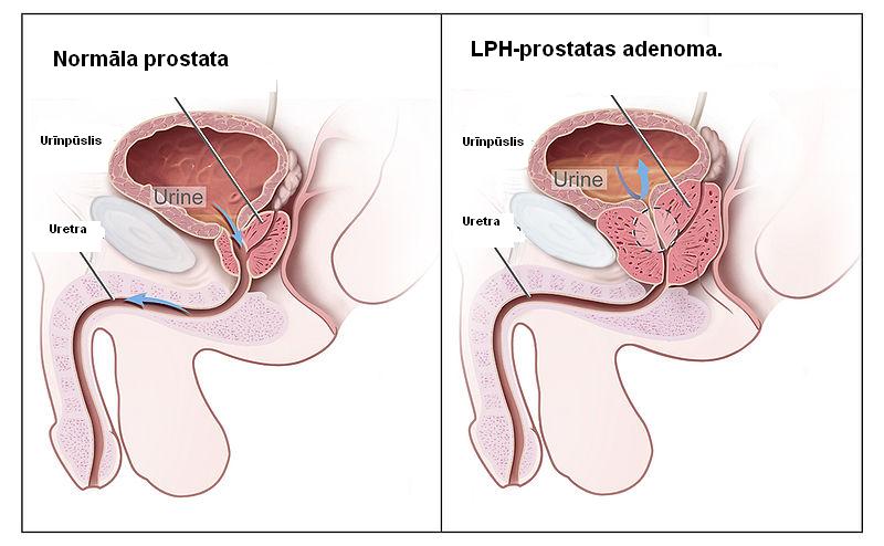 Prostatas adenoma